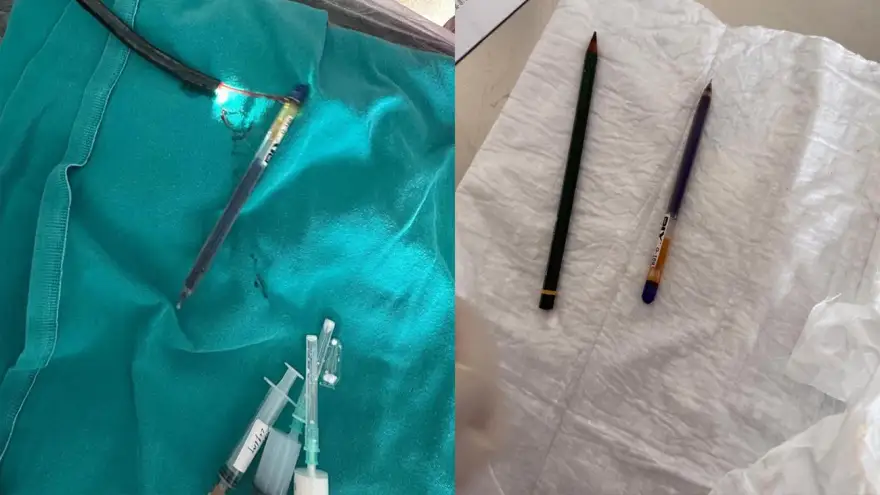 Ağrı’da genç kadının midesinden endoskopiyle iki kalem çıkarıldı